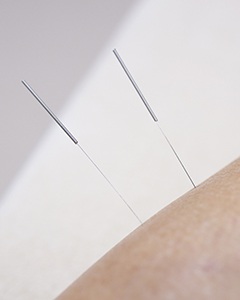 DryNeedling